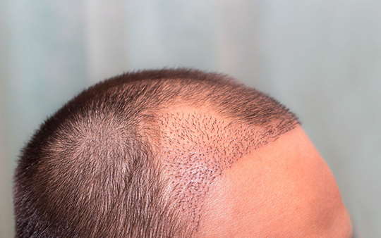 Hair Transplant & Laser Hair Removal Services Near Town Hall Get advanced hair transplant and laser hair removal by skilled surgeons Near Town Hall, Coimbatore