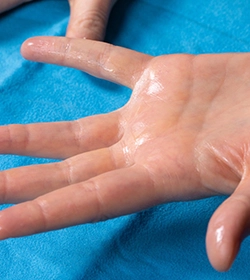 Close-up of sweaty palm showing symptoms of hyperhidrosis, treated with botulinum injection