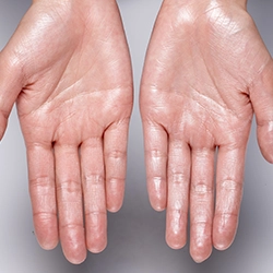 Botox blocks nerve signals to reduce underarm, hand, and foot sweating for lasting hyperhidrosis relief
