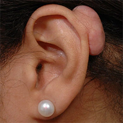 Keloid Removal Surgery Treatment near Singanallur for scar-free and smooth skin results.