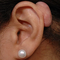 Keloid Removal Surgery Treatment near R.S. Puram, Coimbatore for scar-free and smooth skin results.