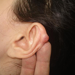 Keloid removal surgery treatment Near Kalapatti, Coimbatore for scar-free and smooth skin results.