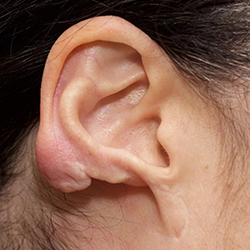 Earlobe reduction and keloid removal surgery near Gandhipuram by plastic surgery experts.