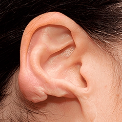 Keloid scar removal near Ukkadam, Coimbatore to treat raised scars after ear piercings and restore smooth, healthy skin.