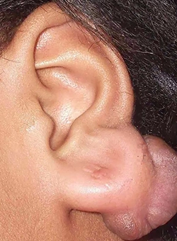Expert keloid scar removal near Town Hall, Coimbatore using surgical excision and steroid therapy for smooth healing.