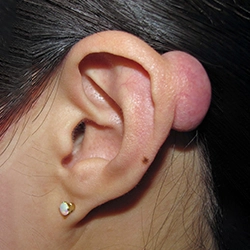 Keloid removal surgery treatment Near Ondipudur, Coimbatore for scar-free and smooth skin results.