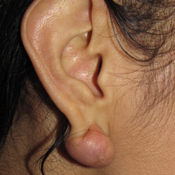 Keloid removal surgery treatment in Peelamedu, Coimbatore for scar-free and smooth skin results.
