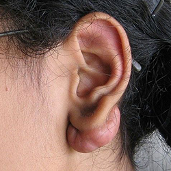 Get keloid scar removal surgery or treatment near Saibaba Colony for smoother, clearer skin results.