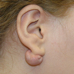 Keloid Removal Surgery Treatment Near Ramanathapuram for scar-free and smooth skin results.