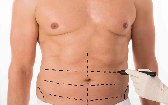 Liposuction Fat Reduction Surgery Near Gandhipuram, Coimbatore We offer liposuction fat reduction surgery near Gandhipuram, Coimbatore, for body contouring & shaping.