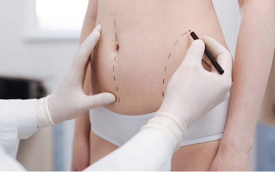 Liposuction fat removal surgery near Race Course Coimbatore for body contouring and sculpting with expert care