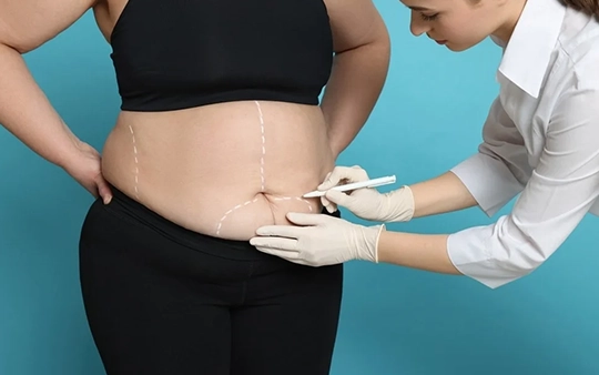 Liposuction Surgery in Udayampalayam, Coimbatore Remove stubborn fat and contour your body with expert liposuction surgery in Udayampalayam