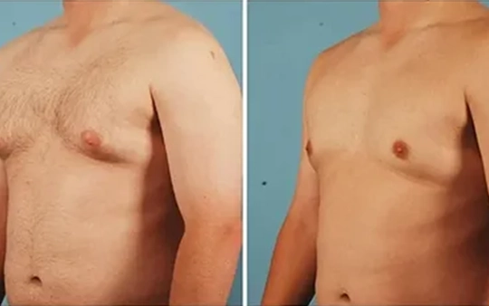 Get a sculpted, natural-looking chest with safe male chest reduction for lasting confidence.