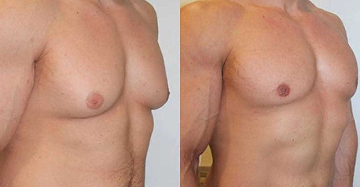 Safe and effective male breast reduction surgery in Gandhipuram, Coimbatore with expert care and results