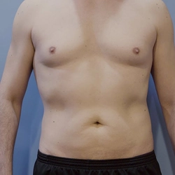 Safe drug-induced gynecomastia surgery in Gandhipuram, Coimbatore with discreet male breast reduction