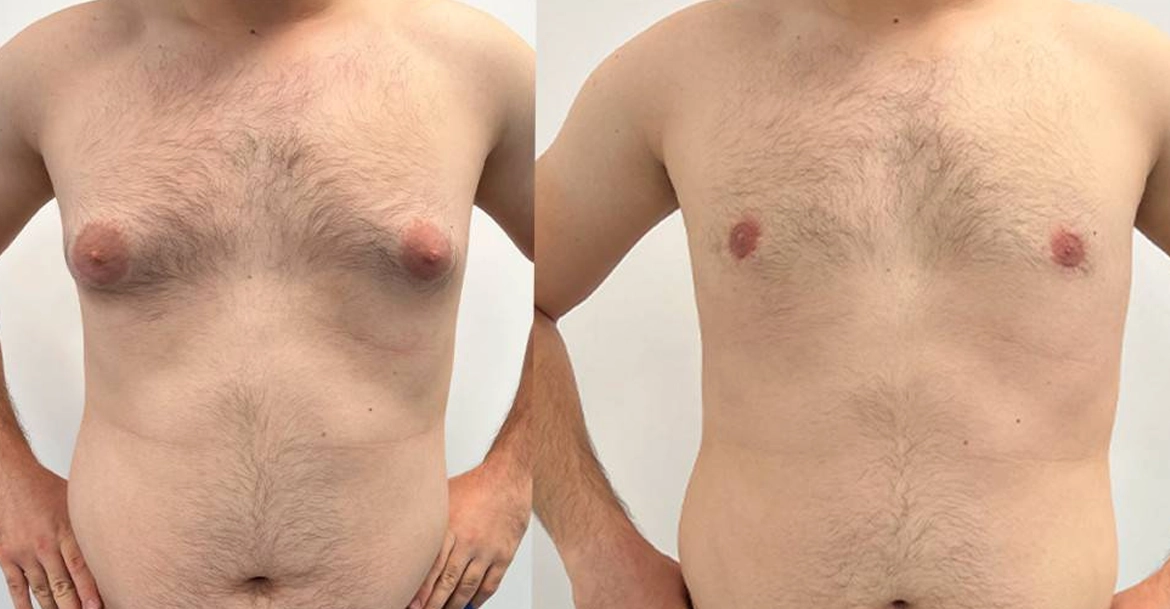 Male breast reduction surgery in Singanallur to removes extra tissue or fat for a natural chest