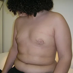 Safe mixed gynecomastia surgery in Gandhipuram, Coimbatore using liposuction and gland removal for balance