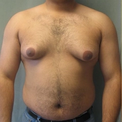 Mixed gynecomastia surgery in Singanallur, Coimbatore combines liposuction and gland removal for balance