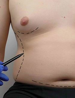 Specialized surgeons perform mixed gynecomastia fat and gland removal at Sushruta Centre, Peelamedu.