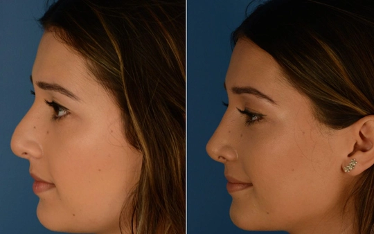 Rhinoplasty And Nose Reshaping Surgery Near Gandhipuram Get the Best Rhinoplasty and Nose Reshaping Surgery for Natural Results with Expert Surgeons