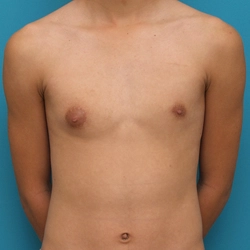 Effective unilateral and bilateral gynecomastia surgery in Singanallur, Coimbatore for a balanced chest