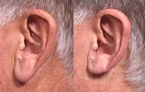 Before and after pictures of earlobe correction near Town Hall, Coimbatore showing natural-looking results.