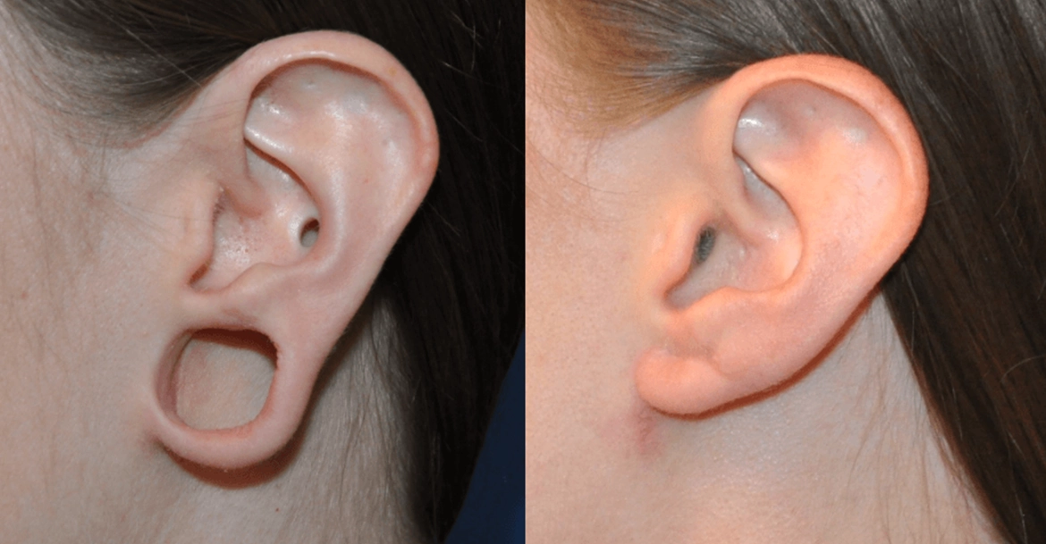 Earlobe repair and ear hole reconstruction treatment by expert cosmetic surgeons near Ukkadam, Coimbatore.
