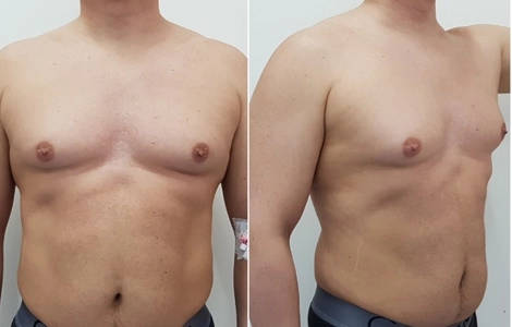 Identify the ideal candidate for male breast reduction surgery in Gandhipuram for a natural chest shape