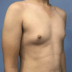 Safe pubertal gynecomastia surgery in Singanallur, Coimbatore removes extra tissue for a flat, natural chest