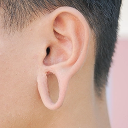 Repair stretched earlobes from spacers near Ukkadam, Coimbatore for a natural and neat appearance.