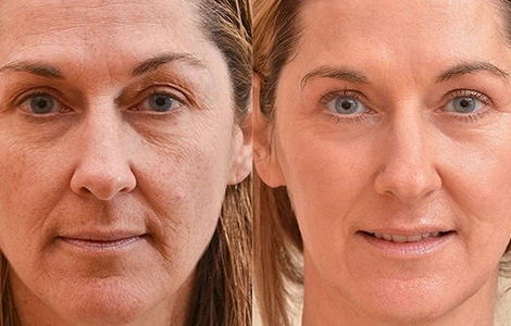Before and after Botox results showing reduced wrinkles and fine lines near Gandhipuram, Coimbatore