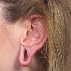 Advanced stretched earlobe repair from spacers in Peelamedu with minimal scarring and fast recovery.