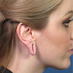 Split Earlobe Repair and Ear Hole Stitching Surgery Services Available Near Kalapatti Coimbatore