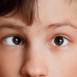 Strabismus correction using Botox to align eyes and improve vision clarity in Ondipudur