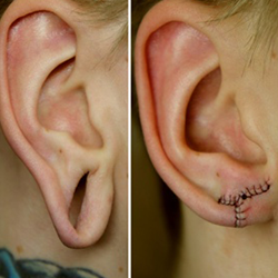 Split Earlobe Repair and Ear Hole Stitching Surgery Services Available Near Ramanathapuram