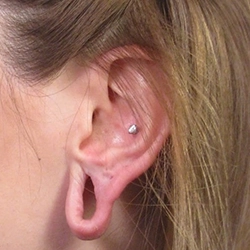 Split Earlobe Repair and Ear Hole Stitching Surgery Services Available near R.S. Puram, Coimbatore