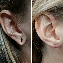 Stretched Earlobe Reconstruction Treatment and Repair Services Available Near Kalapatti Coimbatore