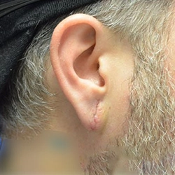 Split Earlobe Repair and Ear Hole Stitching Surgery Services Available Near Ondipudur, Coimbatore