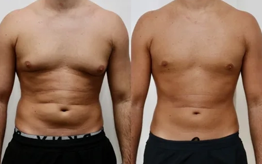 Male breast reduction surgery near Vadavalli, Coimbatore to achieve a firmer, masculine chest