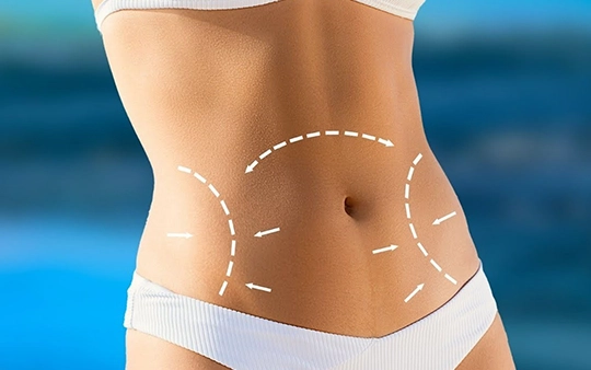 Tummy tuck (abdominoplasty) treatment near Vadavalli, Coimbatore for a toned and flat abdomen
