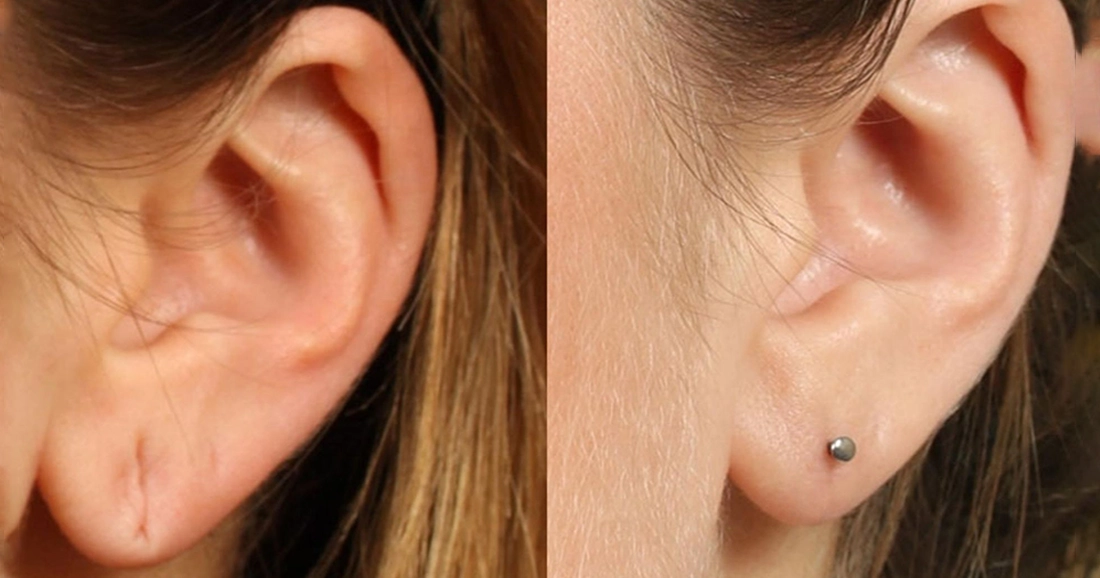 Affordable Earlobe Repair Surgery and Ear Hole Stitching Services Near Ondipudur Coimbatore
