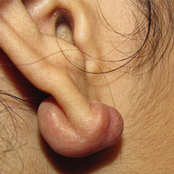 Keloid removal surgery treatment Near Trichy Road, Coimbatore for scar-free and smooth skin results.