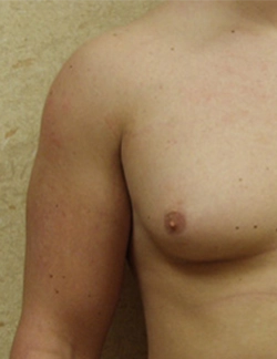 Skilled surgeons provide true gynecomastia gland removal surgery at Sushruta Cosmetic Centre, Peelamedu.