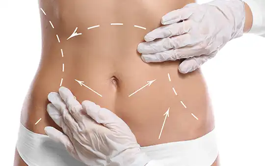 Expert tummy tuck surgery in Coimbatore to remove excess skin and fat for a toned, flat abdominal profile.
