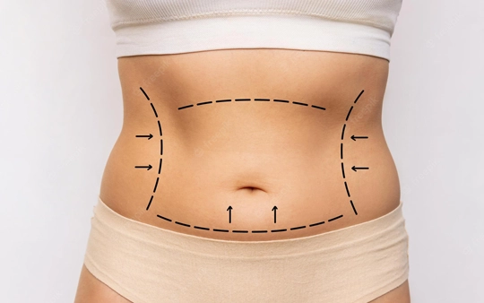 Best Tummy Tuck Treatment Near Gandhipuram, Coimbatore We offer the best tummy tuck treatment to remove excess belly fat and tighten abdominal muscles.