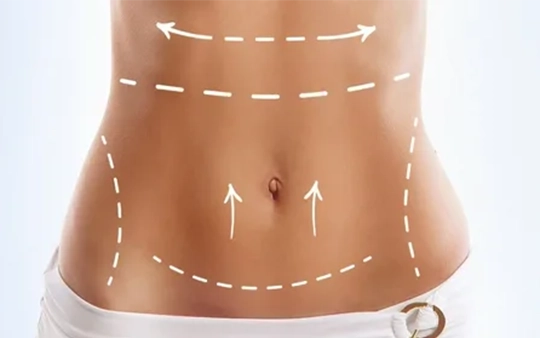 Tummy tuck surgery near Race Course Coimbatore for fat removal and body contouring with expert care