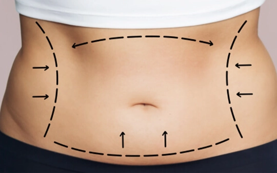 Tummy Tuck Surgery in Udayampalayam, Coimbatore Flatten your abdomen with expert tummy tuck surgery in Udayampalayam, Coimbatore for a toned body shape.