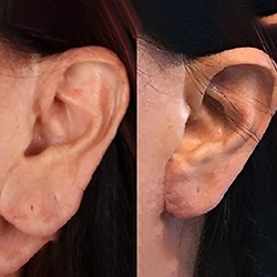 Correct uneven earlobes with safe ear correction surgery Near Ondipudur for natural symmetry.