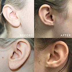 Correct uneven earlobes with safe ear correction surgery near Saibaba Colony for natural symmetry.
