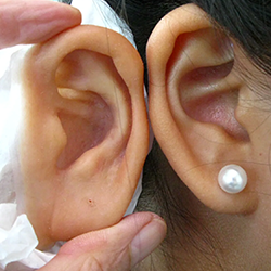 Correct uneven earlobes with safe ear correction surgery Near Singanallur for natural symmetry.